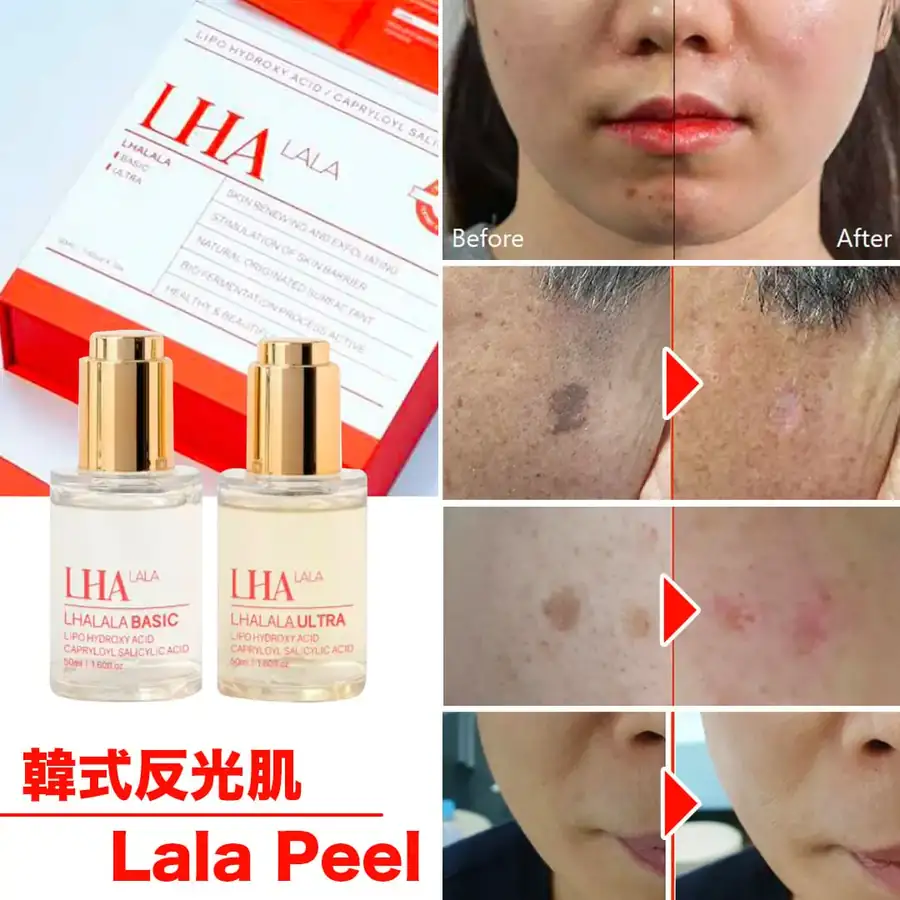 LHALA Peel flacons Basic en Ultra met voor- en na-beelden van pigmentvlekken en huidtextuur